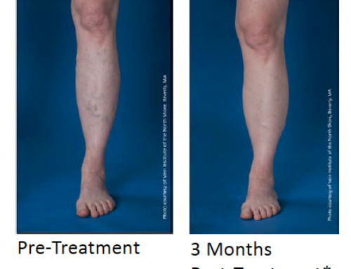 Varicose Veins: Far More Than a Cosmetic Condition